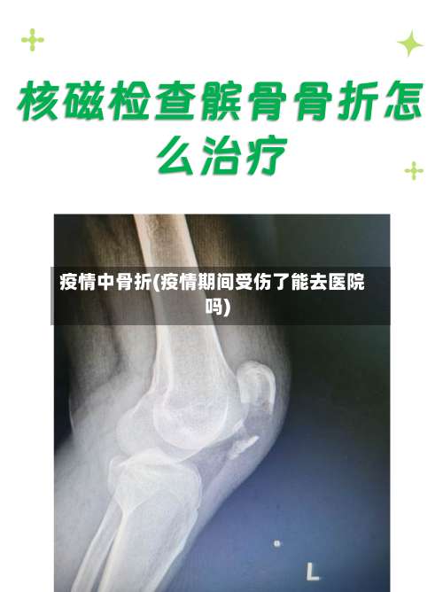 疫情中骨折(疫情期间受伤了能去医院吗)