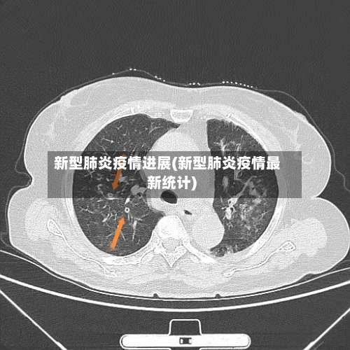 新型肺炎疫情进展(新型肺炎疫情最新统计)